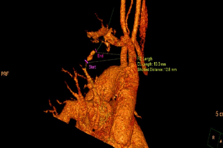 .  Distal proximal area of heart showing diameter of aneurysm.