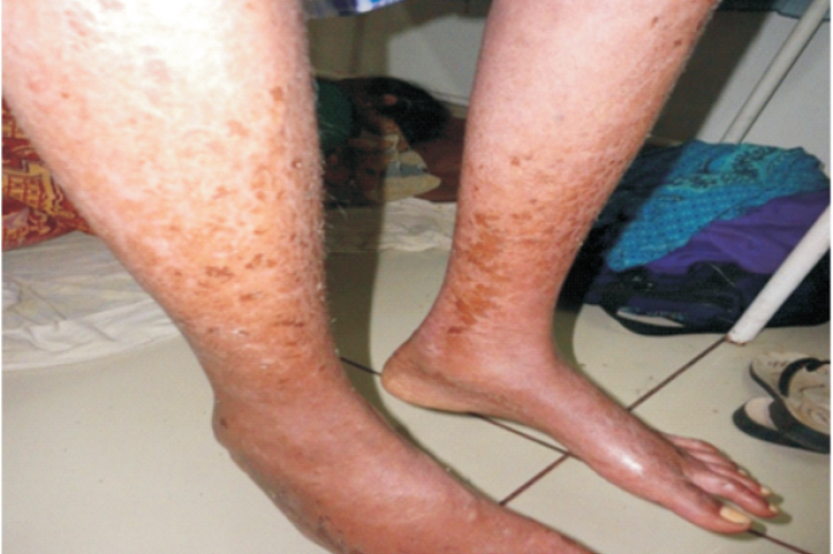  Scaly eruptions and skin lesions of leg