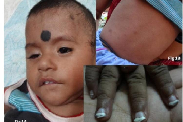Photograph showing congenital anomalies in the child. A-defect in right eye with lagophthalmous, flattening of nasal bridge and widely spaced ears, B-Skin rashes, C-Abnormal nails