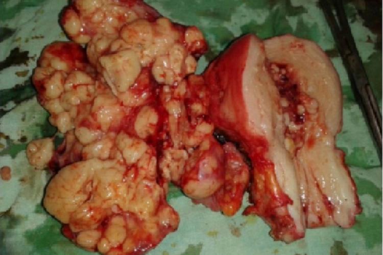 Enlarged multinodular ovarian tumor with uterus showing thickened endometrium