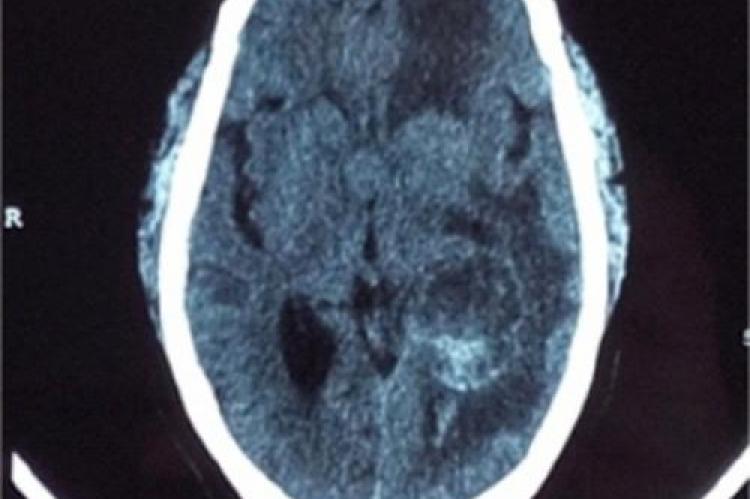  CECT scan axial section showing multiple brain metastases in left frontal