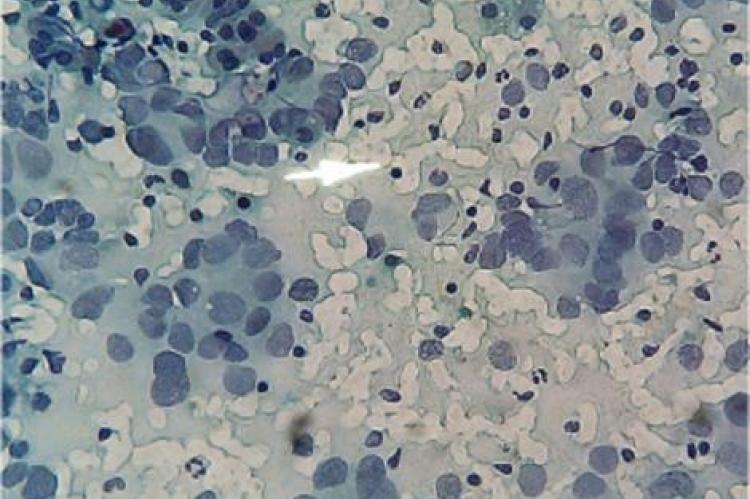 Papanicolaou stain of ascitic fluid (centrifuged) showing adenocarcinoma