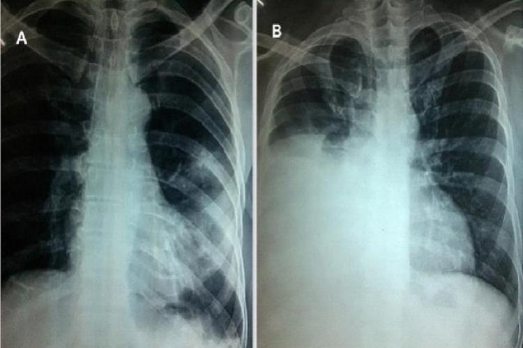 Some imaging findings of patients with RTI: A- left sided pneumonia; B- right sided pneumonia with pleural effusion