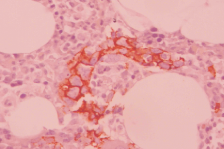  Immunohistochemistry with CD20 highlights the intravascular atypical B lymphocytes