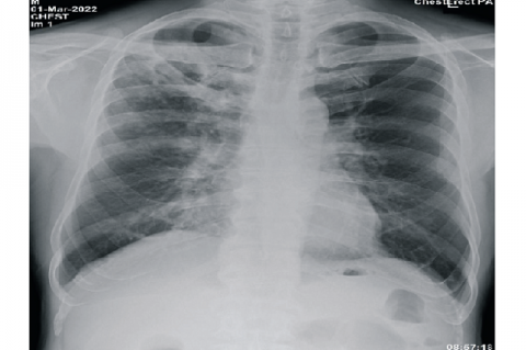 Chest X-Ray : March 1st ,2022