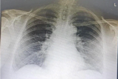 Chest X-ray before taking bevacizumab