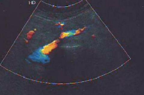 Venous Doppler image showing extensive deep vein thrombosis