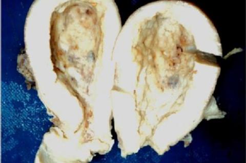 Dilated uterine cavity showing irregularly folded & thickened mucosal surface having small gray white nodular growth.