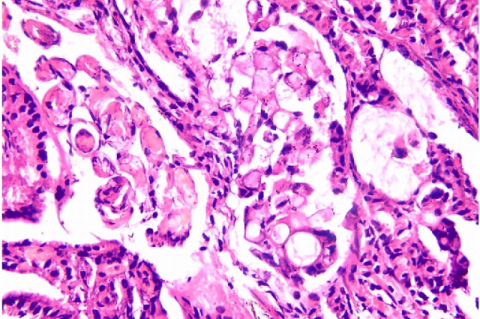  Histopathology showing signet ring cell adenocarcinoma of stomach ( H & E X 400)