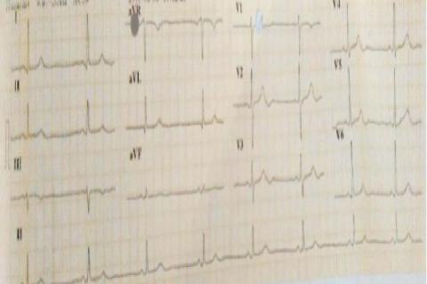 : ECG showing sinus bradycardia upon administration of steroid pulse therapy on the third day of hospitalization