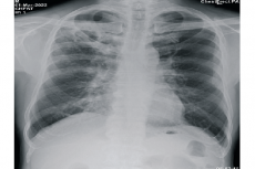 Chest X-Ray : March 1st ,2022