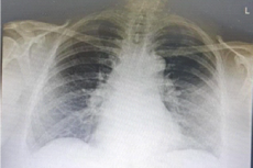 Chest X-ray before taking bevacizumab